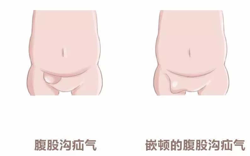 儿童疝气的症状表现及危害有哪些